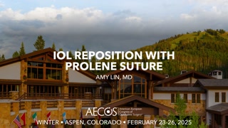 IOL Reposition with Prolene Suture