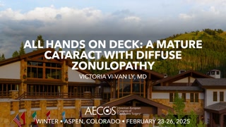 All Hands on Deck – A Mature Cataract with Diffuse Zonulopathy